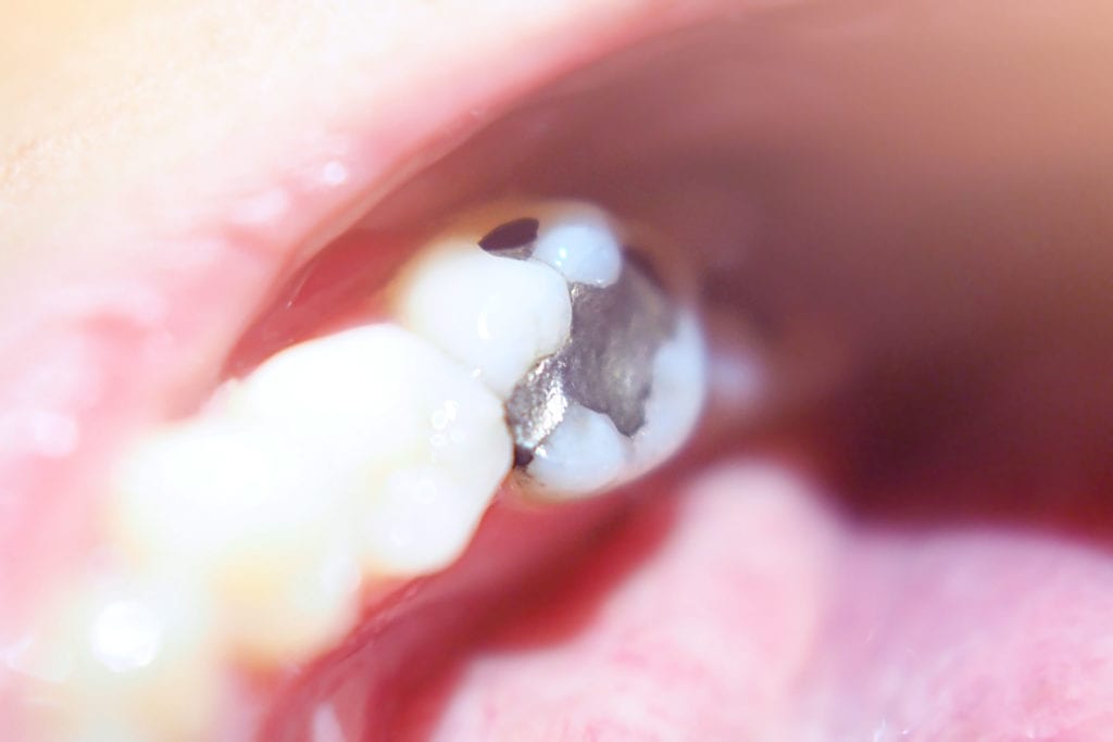 dental amalgam filling