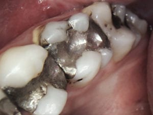 amalgam-fillings