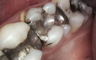 amalgam-fillings