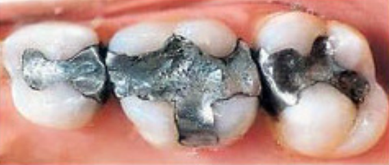 Close-up of a person's teeth Description automatically generated