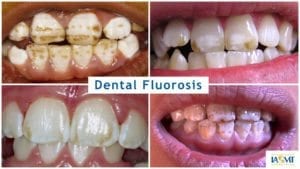 dental fluorosis examples