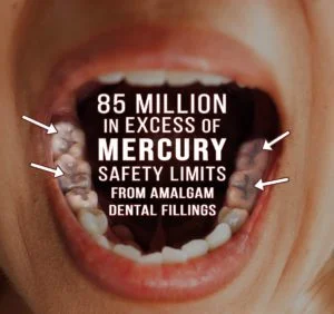Cirugía dental y problemas de salud bucal. foto de boca abierta con empastes de amalgama dental de mercurio