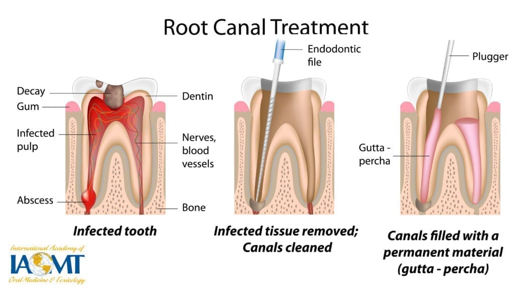 root canal treatment, tooth, infection, decay, gum, abscess, infected pulp, dentin, nerves, blood vessels, endodontic file, clean, plugger, gutta-percha