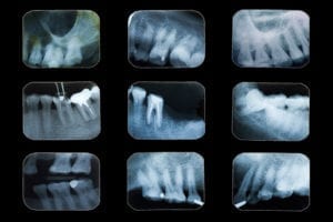 dental x-ray film